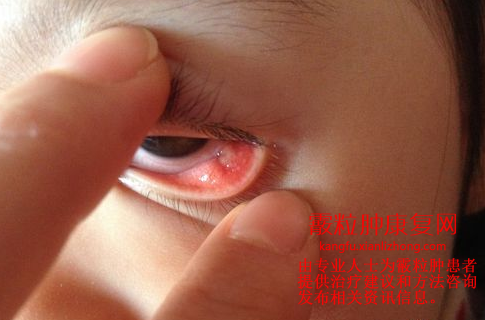 霰粒肿图片