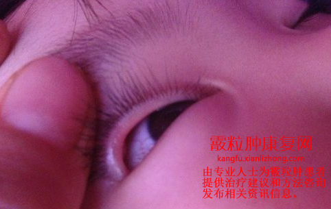 霰粒肿图片